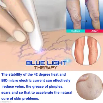 1pc Prenosni Medicinske Modra Svetloba Zdravljenje Aken Laser Pero Kože, Odstranjevanje Madežev Pero Anti Krčne Pajek Vene Radirka Zdravljenje